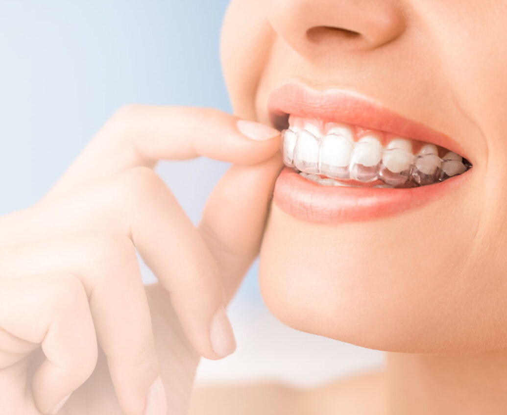 Invisalign Braces in Radcliffe on Trent