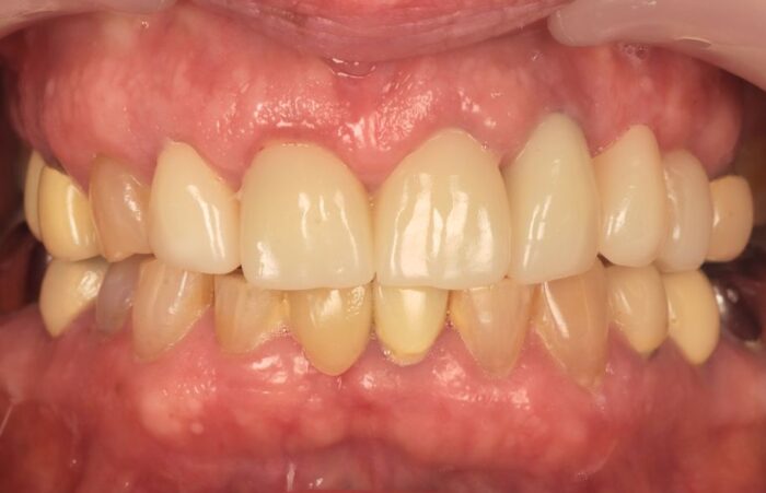 After - Dent Blanche Implant & Dental Centre Road Dental