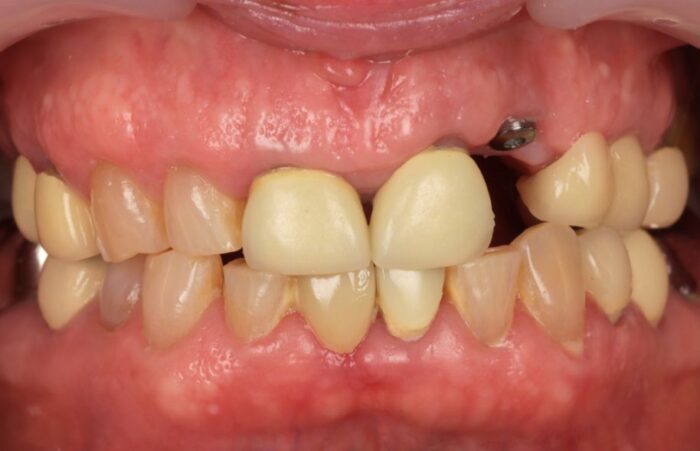 Before -  Dent Blanche Implant & Dental Centre Road Dental