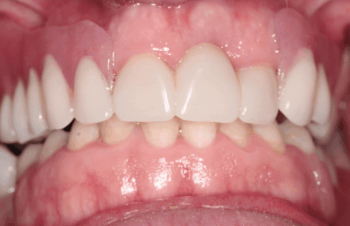 After - Dent Blanche Implant & Dental Centre Road Dental