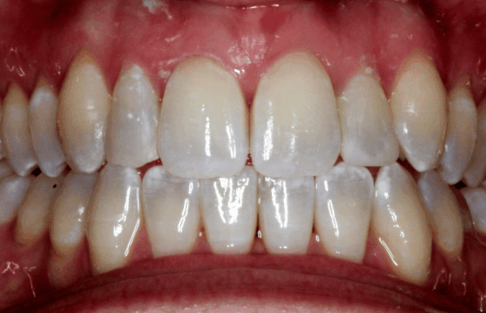 After - dentblanche