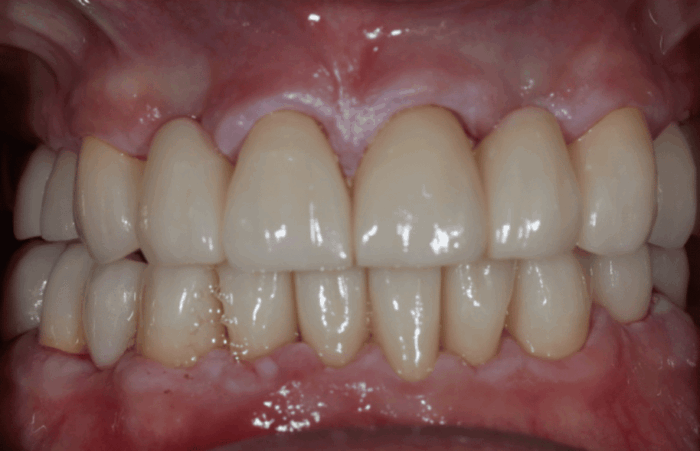 After - Dent Blanche Implant & Dental Centre Road Dental