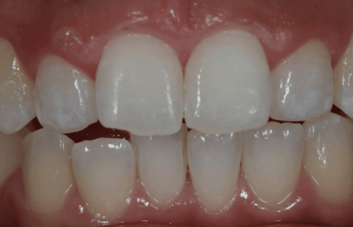After - Dent Blanche Implant & Dental Centre Road Dental