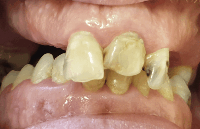Before -  Dent Blanche Implant & Dental Centre Road Dental