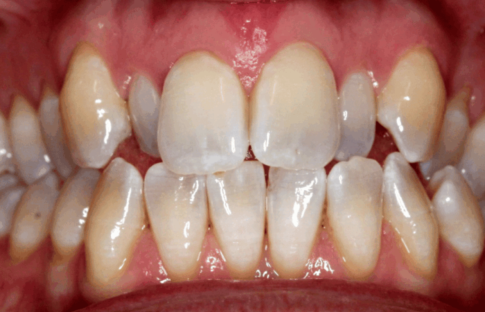 Before - dentblanche