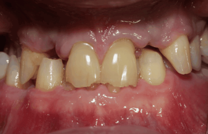 Before -  Dent Blanche Implant & Dental Centre Road Dental