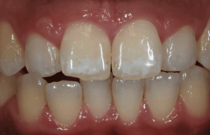 Before -  Dent Blanche Implant & Dental Centre Road Dental