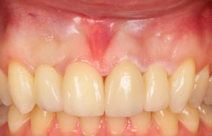 After - Dent Blanche Implant & Dental Centre Road Dental