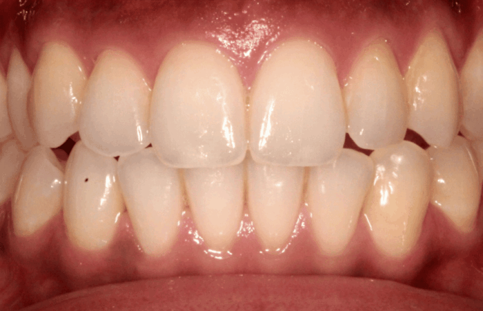 After - dentblanche