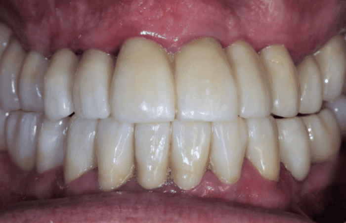 After - Dent Blanche Implant & Dental Centre Road Dental