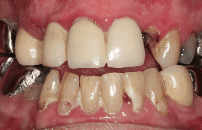 Before -  Dent Blanche Implant & Dental Centre Road Dental