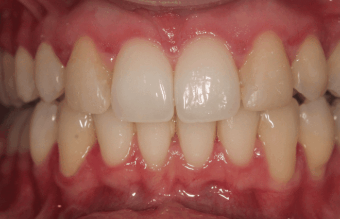After - dentblanche