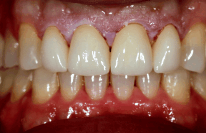 After - Dent Blanche Implant & Dental Centre Road Dental