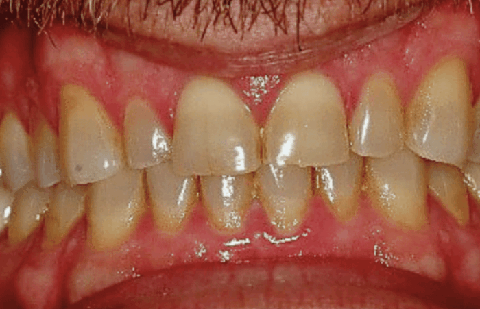 Before -  Dent Blanche Implant & Dental Centre Road Dental