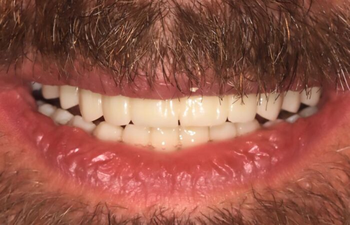 After - Dent Blanche Implant & Dental Centre Road Dental