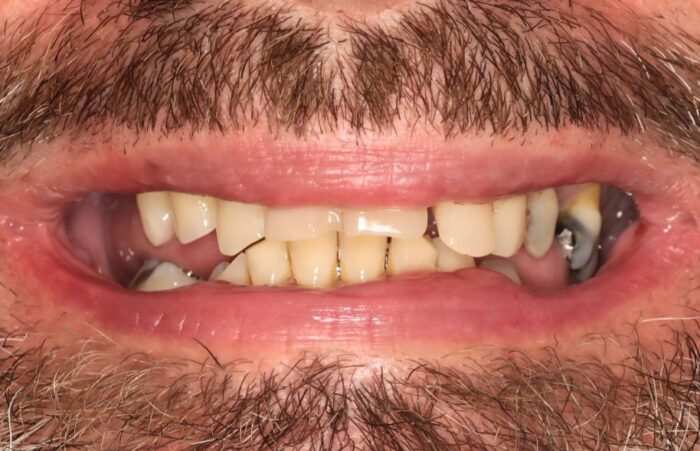 Before -  Dent Blanche Implant & Dental Centre Road Dental