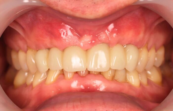 After - Dent Blanche Implant & Dental Centre Road Dental