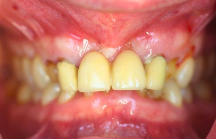 Before -  Dent Blanche Implant & Dental Centre Road Dental