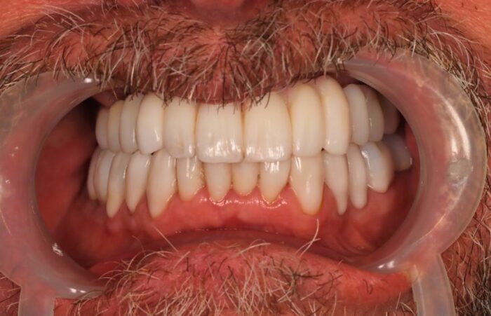 After - Dent Blanche Implant & Dental Centre Road Dental
