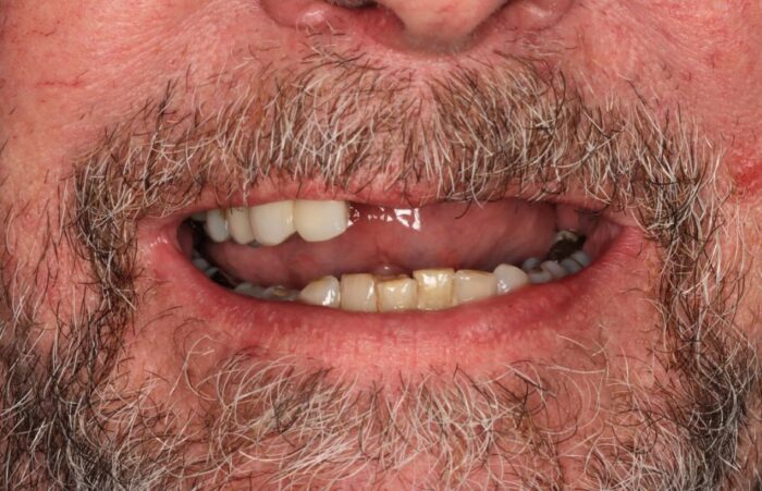 Before -  Dent Blanche Implant & Dental Centre Road Dental