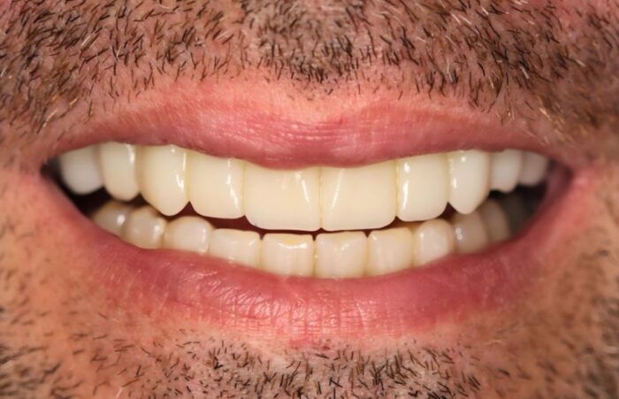 After - Dent Blanche Implant & Dental Centre Road Dental