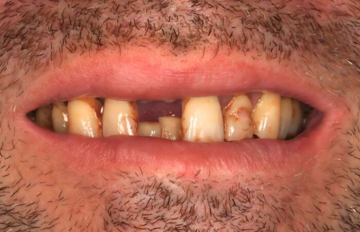 Before -  Dent Blanche Implant & Dental Centre Road Dental