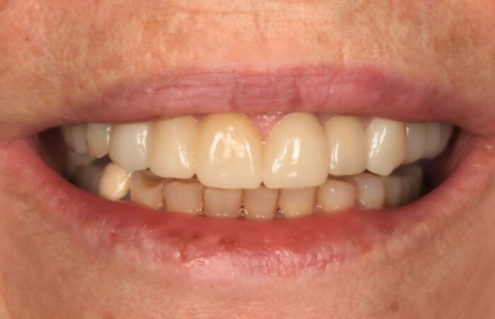After - Dent Blanche Implant & Dental Centre Road Dental