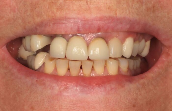 Before -  Dent Blanche Implant & Dental Centre Road Dental