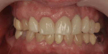 dentblanche