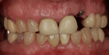 dentblanche