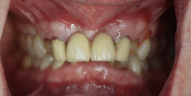 dentblanche