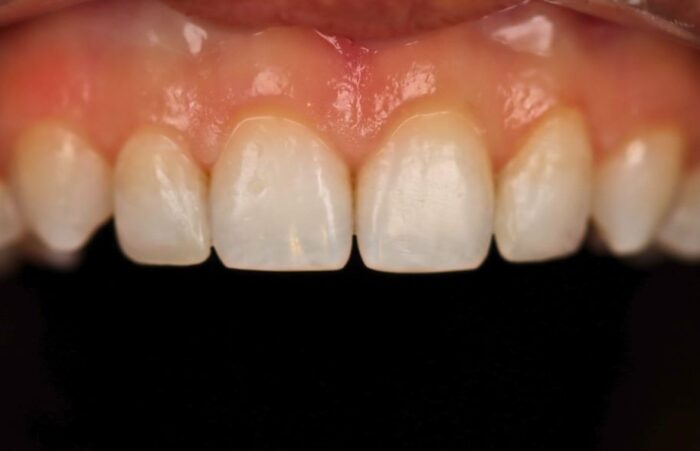 After - Dent Blanche Implant & Dental Centre Road Dental