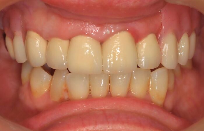 After - Dent Blanche Implant & Dental Centre Road Dental