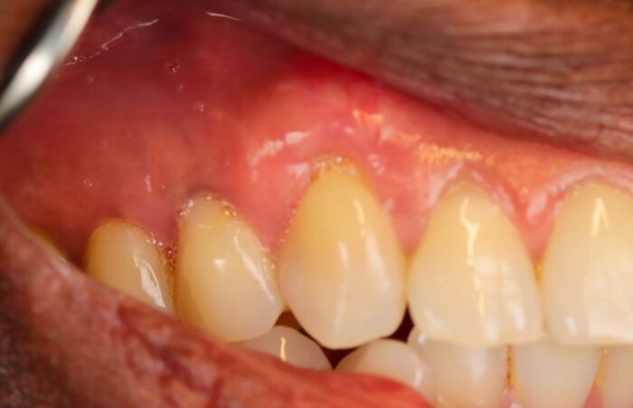 After - Dent Blanche Implant & Dental Centre Road Dental