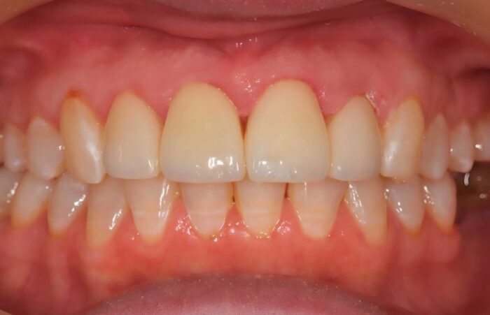 After - Dent Blanche Implant & Dental Centre Road Dental