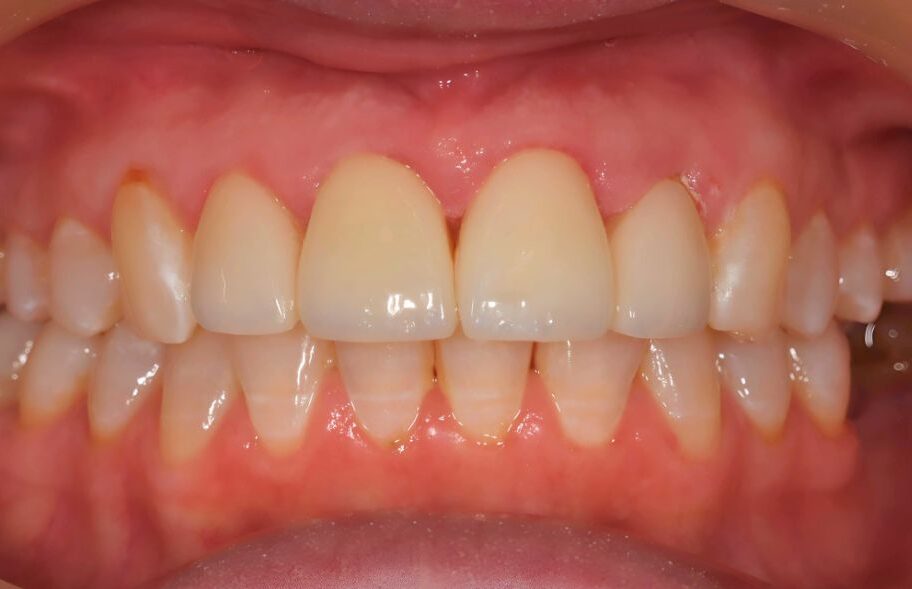 After - Dentblanche