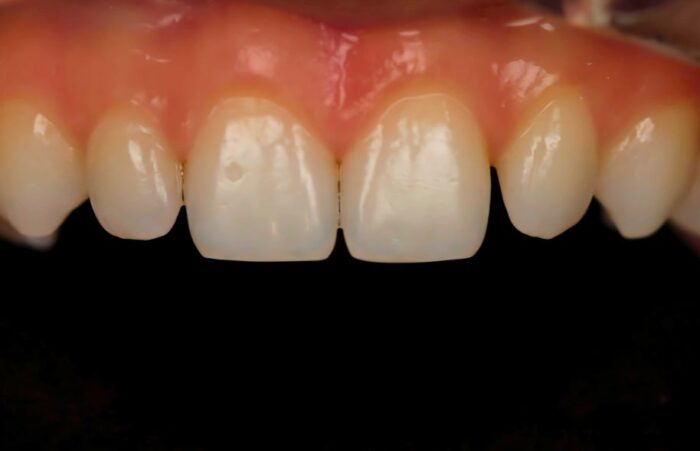 Before -  Dent Blanche Implant & Dental Centre Road Dental