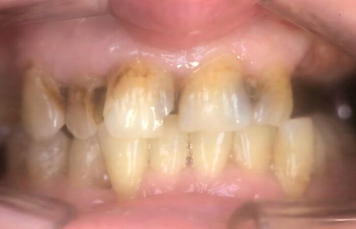 Before -  Dent Blanche Implant & Dental Centre Road Dental