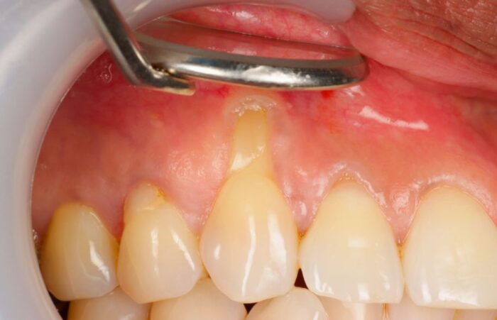 Before -  Dent Blanche Implant & Dental Centre Road Dental