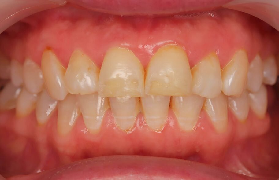 Before - Dentblanche