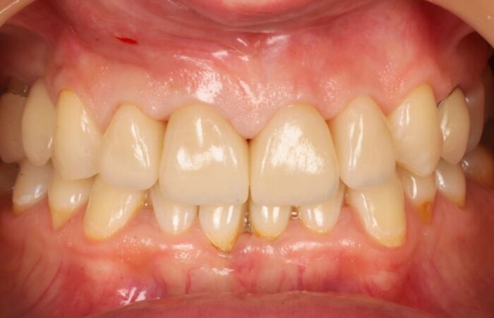 After - Dent Blanche Implant & Dental Centre Road Dental