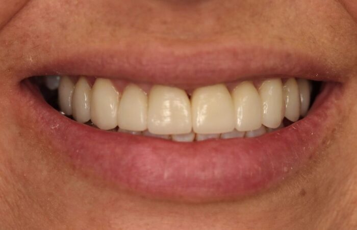 After - Dent Blanche Implant & Dental Centre Road Dental