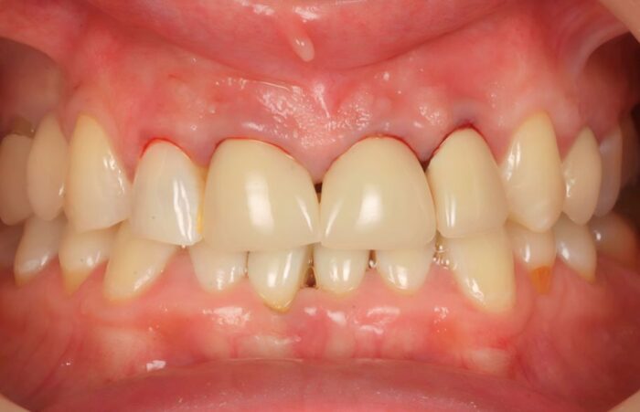 Before -  Dent Blanche Implant & Dental Centre Road Dental