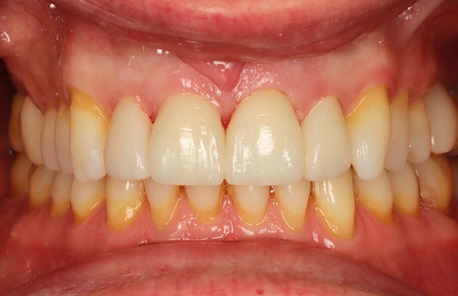 After - Dentblanche