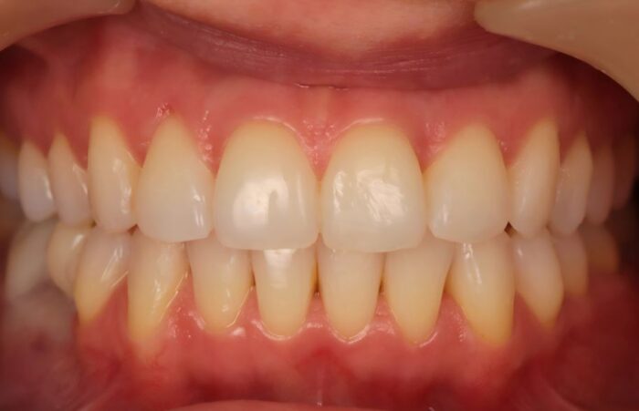 After - dentblanche