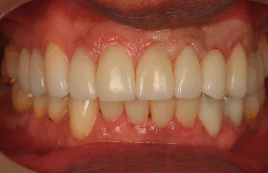 After - Dentblanche