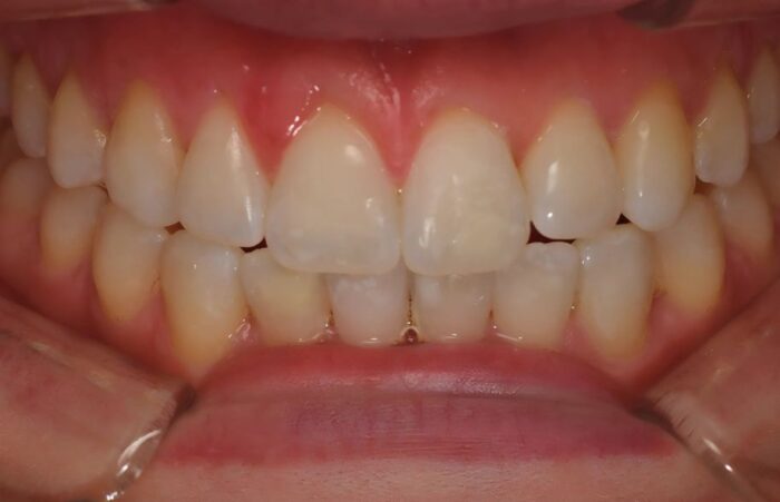 After - dentblanche
