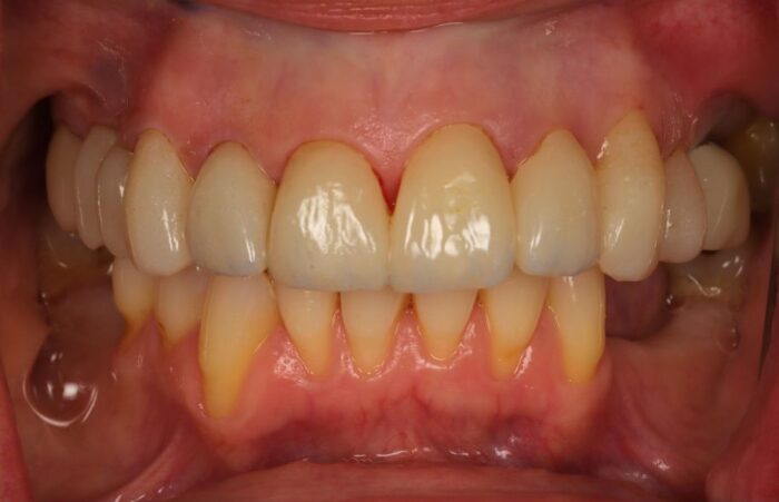 After - Dent Blanche Implant & Dental Centre Road Dental