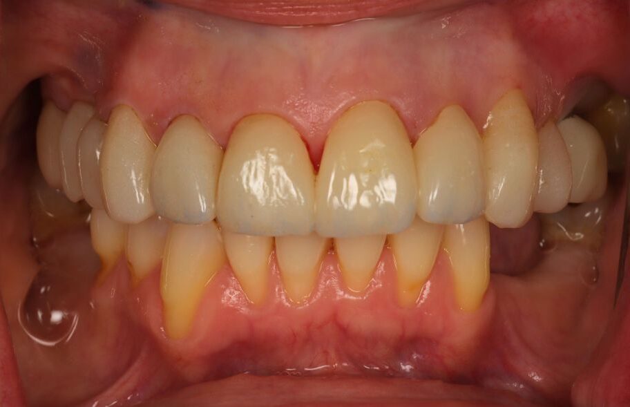 After - Dentblanche