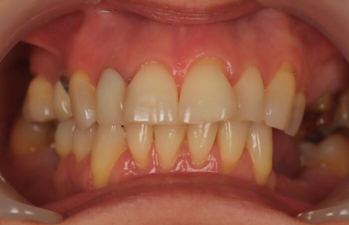 Before -  Dent Blanche Implant & Dental Centre Road Dental